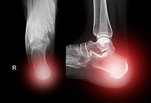 Bone Spurs: Home Remedies