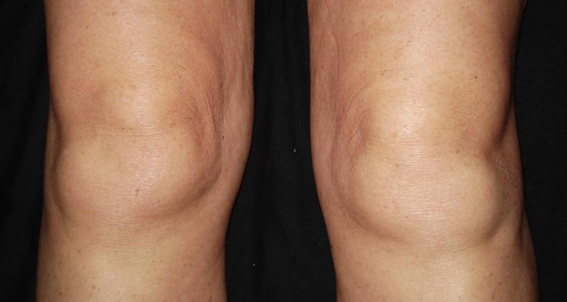 8 Home Remedies to Reduce Knee Swelling Quickly